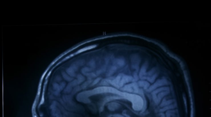 Human Brain - A magnetic resonance imaging scan of the human head